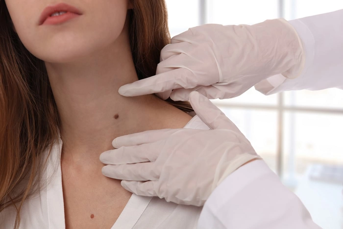 o femeie la un consult dermatologic pentru verificarea alunițelor