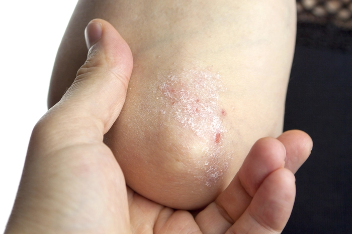 psoriazis pe cot