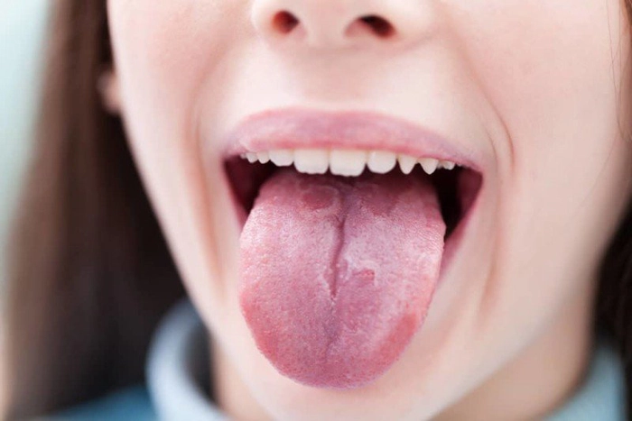 femeie cu gura cascata si cu limba afara care sufera de candida