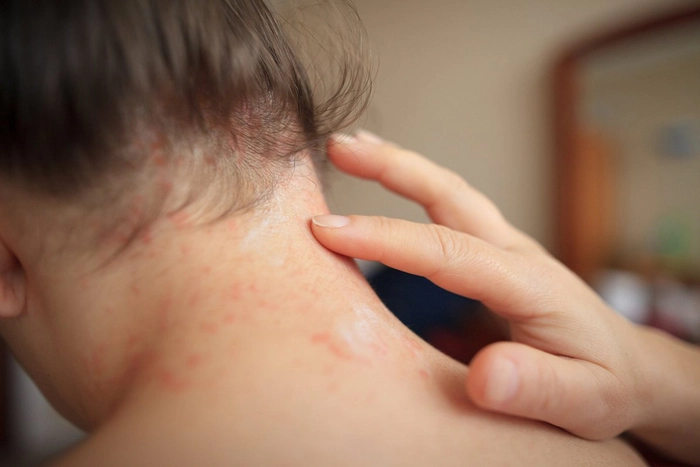 persoana care verifica rana provocata de psoriazis de pe gat a unei persoane