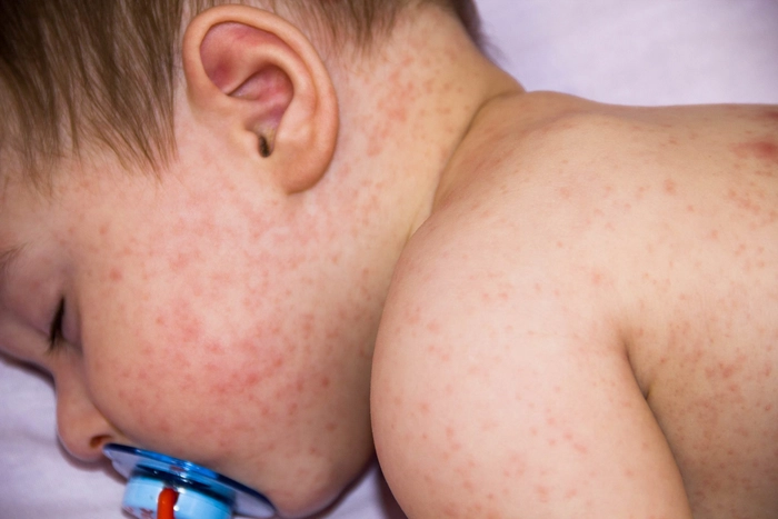 bebelus care sufera de alergie la caldura