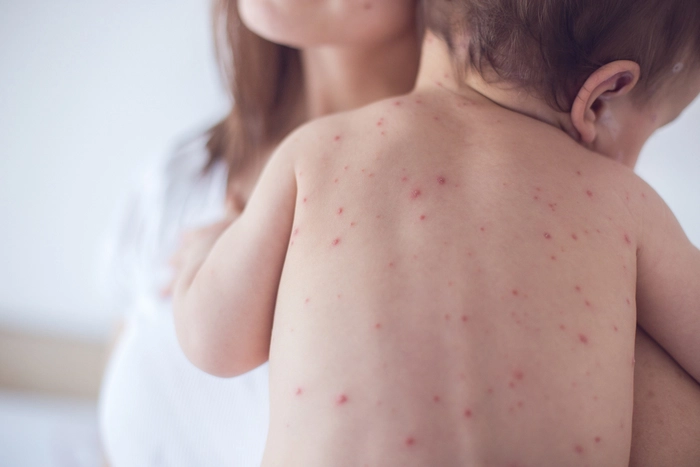 copil care sufera de varicela in bratele unei femei