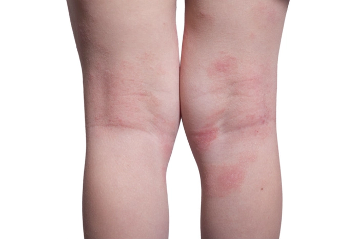 persoana care sufera de eruptii cutanate pe picior provocate de dermatita