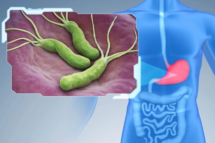 colaj persoana care sufera de dureri de burta cauzate de helicobacter pylori