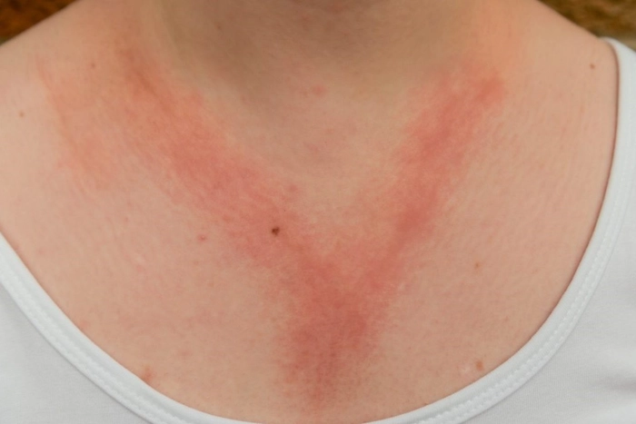 gatul unei persoane care sufera de deramtita atopica