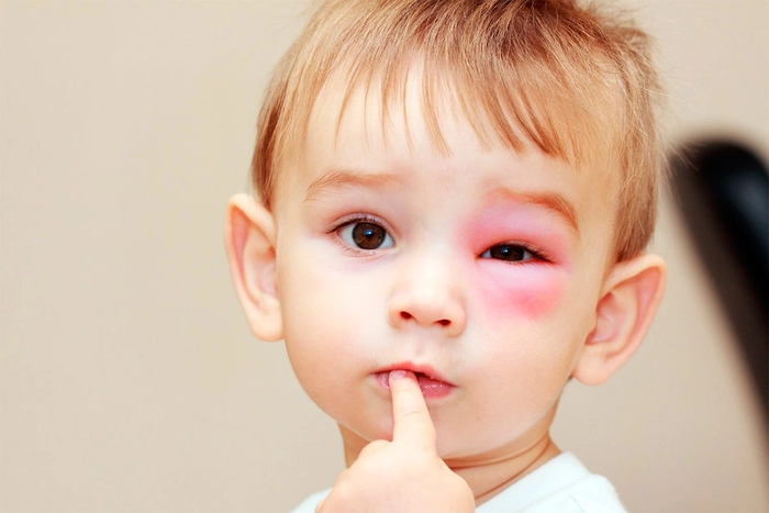 copil care are un ochi umflat