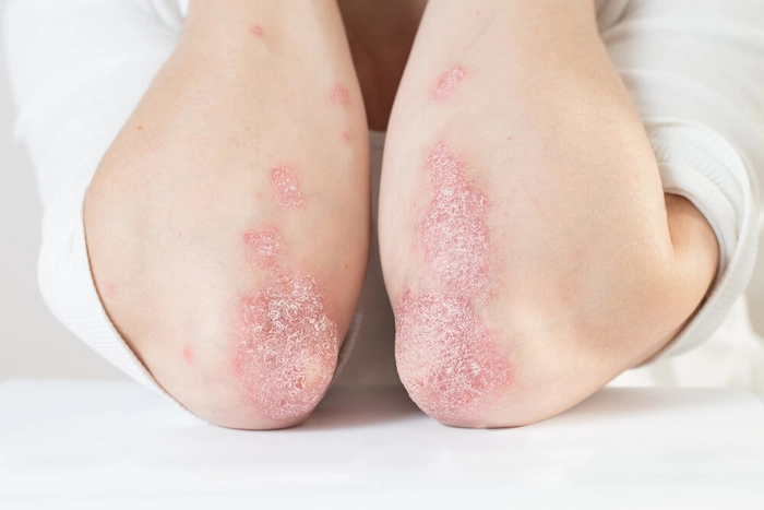 coatele unei persoane care sufera de psoriazis vulgar