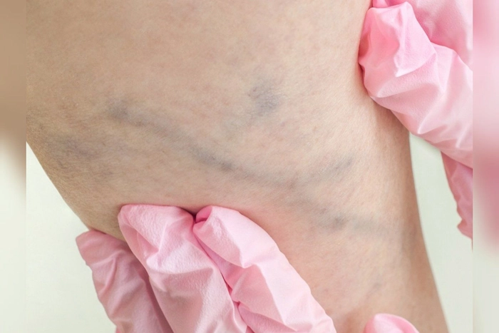 medic care examineaza varicele de pe picioarele unei persoane