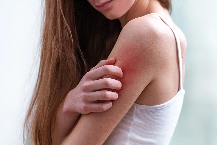 femeie care sufera de o alergie de piele pe sistem nervos si are mancarimi