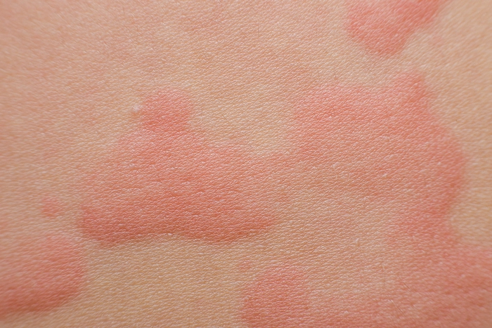 eruptii cutanate pe pielea unei persoane