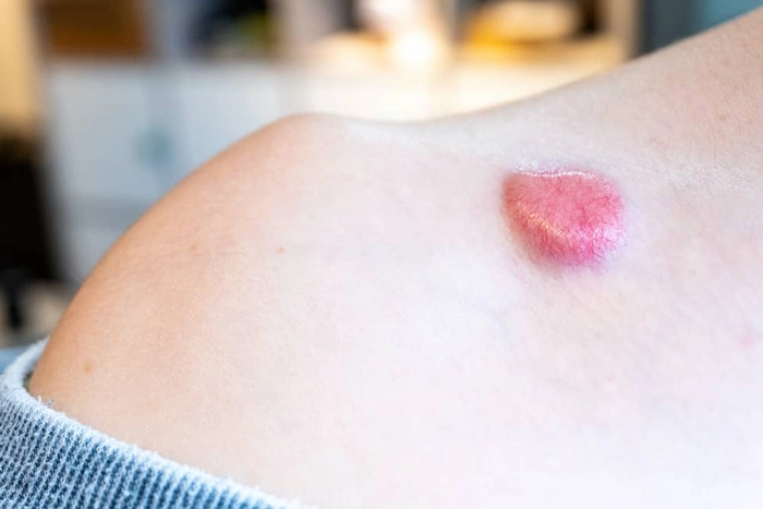 eruptie cutanata pe pielea unei persoane