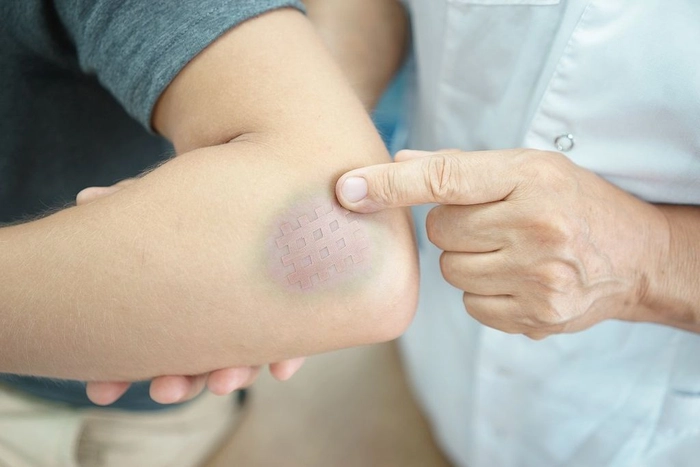 medic care indica cu degetul spre o vanataie de pe mana unei persoane