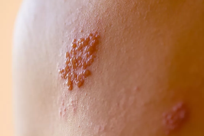 eruptii cutanate pe pielea unei persoane
