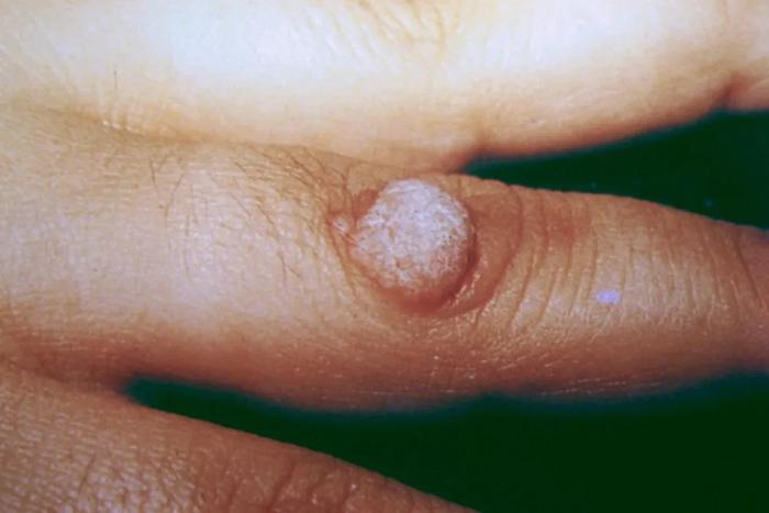 veruci pe degetul unei persoane provocate de hpv
