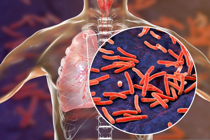  poză cu infecția de tuberculoză