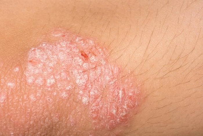 persoana care sufera de eczema