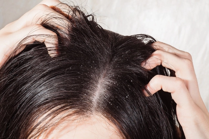un scalp gras cu mătreață