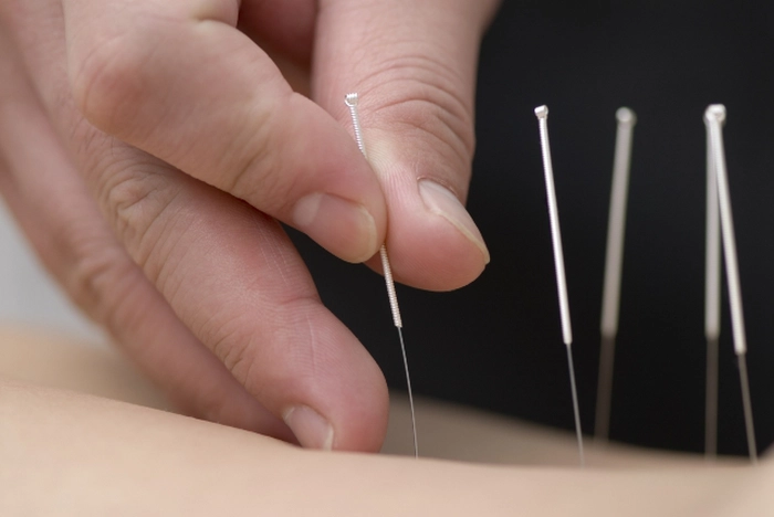 ace folosite la acupunctura