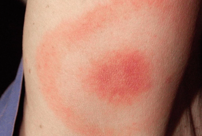 o intepatura extinsa pe mana unei persoane