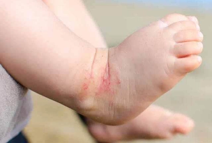 piciorul unui copil care sufera de eczeme