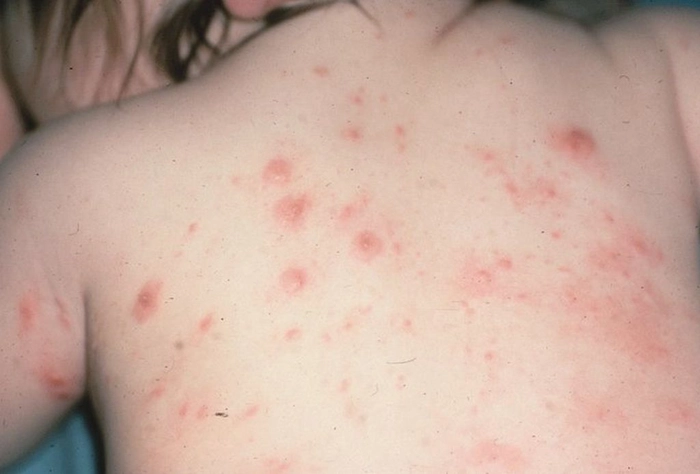 persoana care sufera de scabie