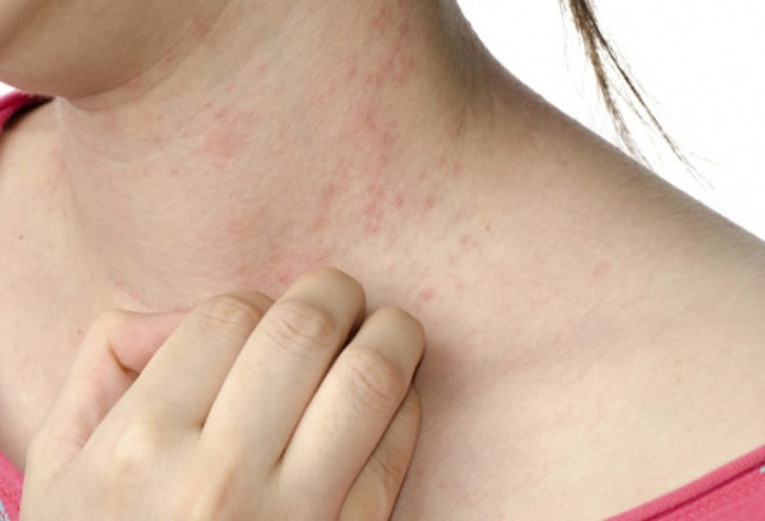 femeie care sufera de mancarime din cauza punctelor rosii de pe corp