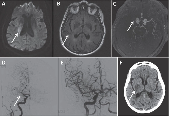 avc ischemic rmn