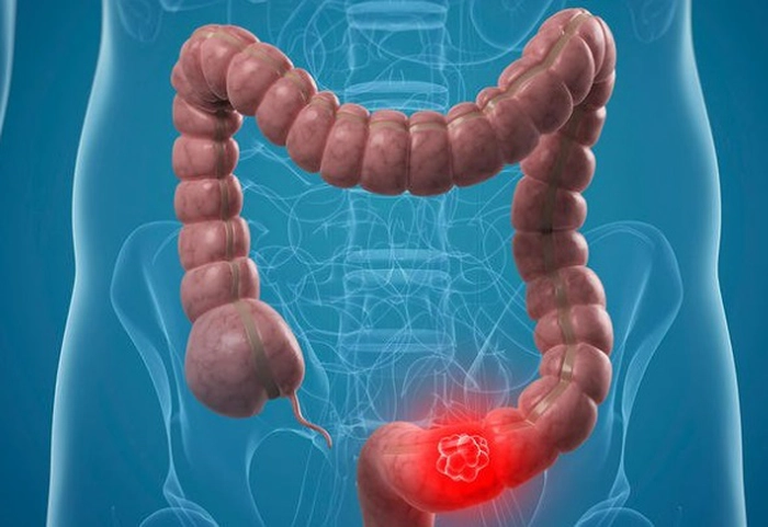 cancer de colon