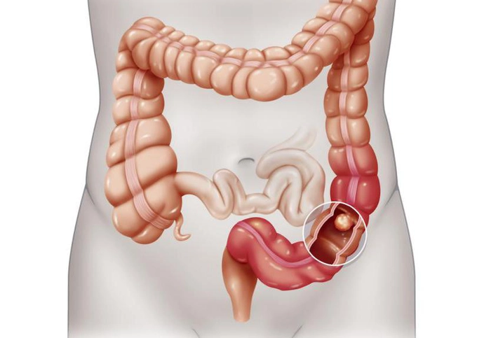 grafica cancer de calon