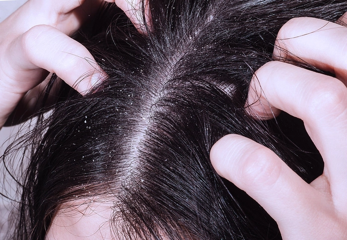 femeie care isi tine mainele in cap si sufera de coji pe scalp