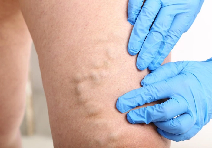 medic care face un control unei persoane care sufera de varice