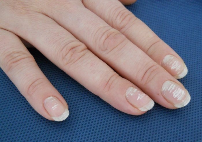 psoriazis unghii