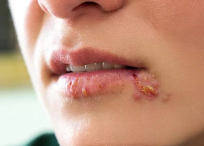 persoană care are herpes bucal