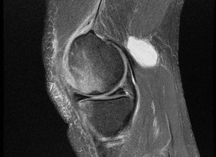 chistul baker la radiografie