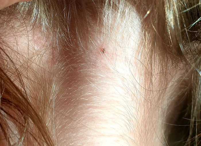 căpușă pe scalp