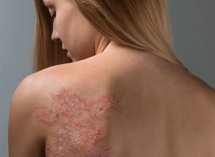spatele unei femei acoperit cu eruptii provocate de psoriazis vulgar