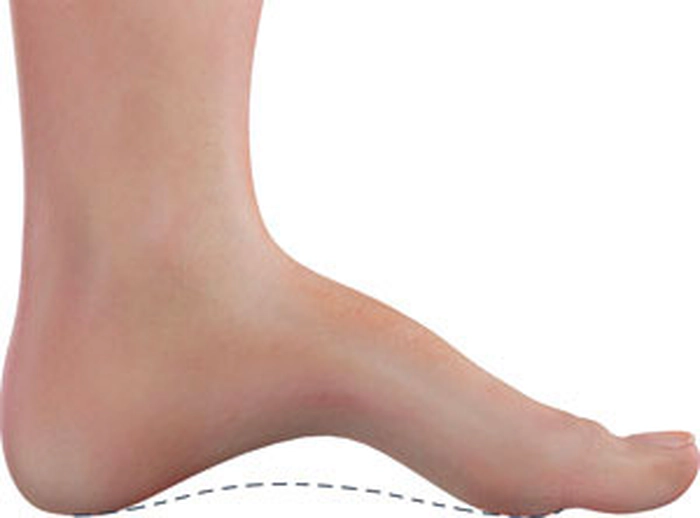 pes cavus