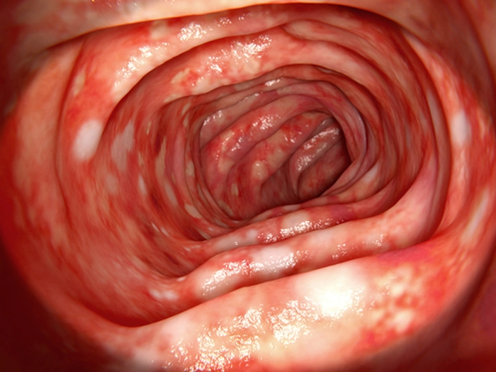 un colon bolnav