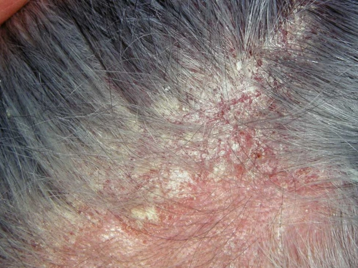 scalp afectat de dermatita seboreica