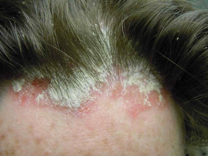 persoana care sufera de o boala a scalpului