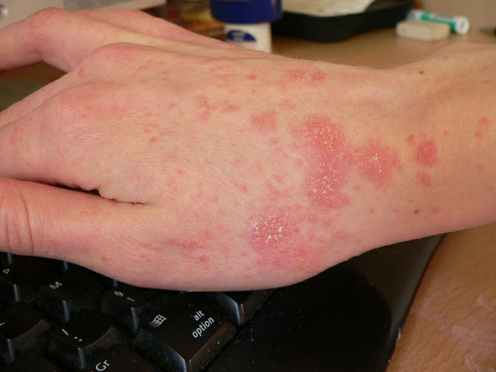 persoana care are eruptii cutanate din cauza scabiei