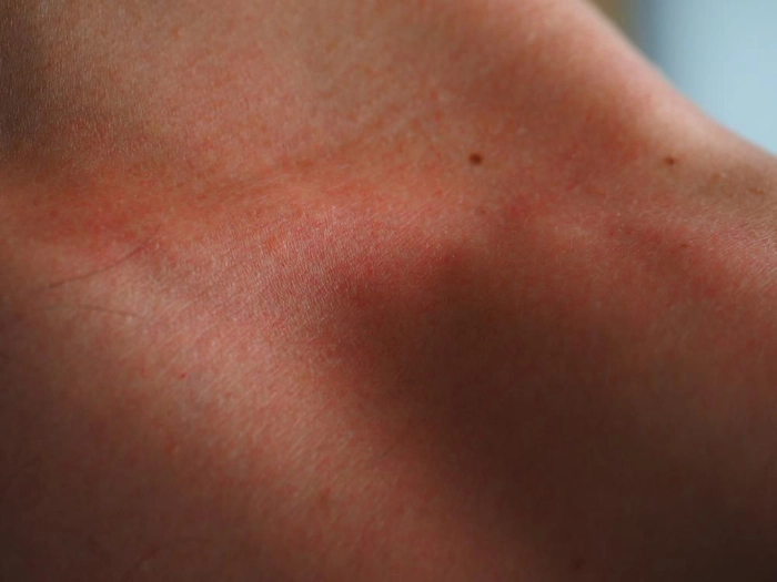 eruptii cutanate pe corp provocate de dermatita