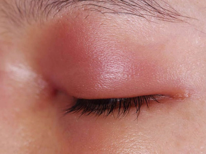 persoana care are pleoapa umflata