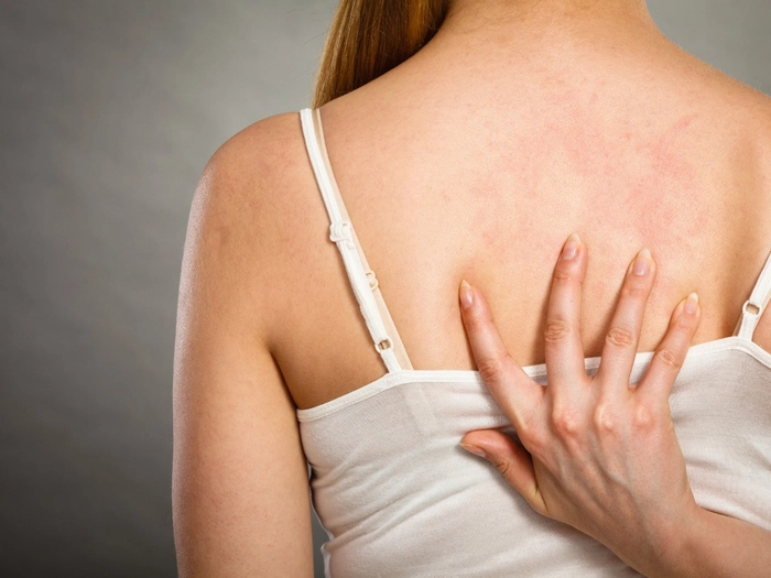 persoana care are eruptii cutanate pe spate provocate de urticarie