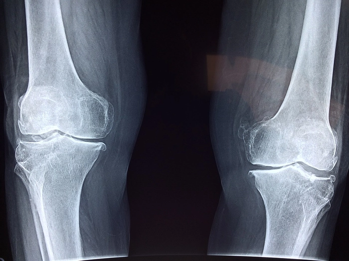 a radiografie care dezvăluie apariția gonartrozei