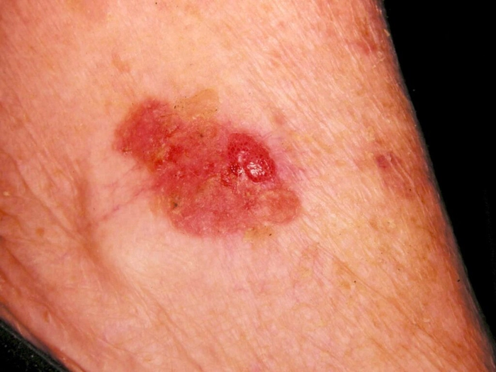 eruptie cutanata pe pielea unei persoane