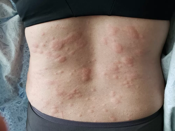 eruptii cutanate pe pielea unei persoane