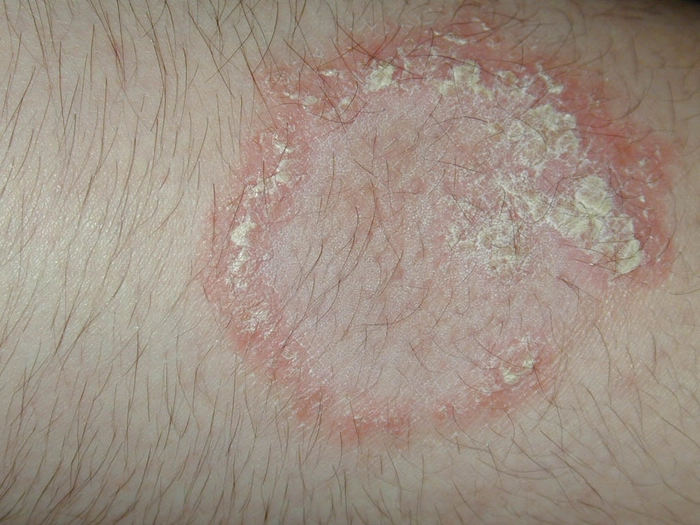 eruptie cutanata pe pielea unei persoane