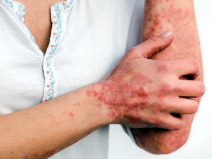 persoana care sufera de eczema pe maini