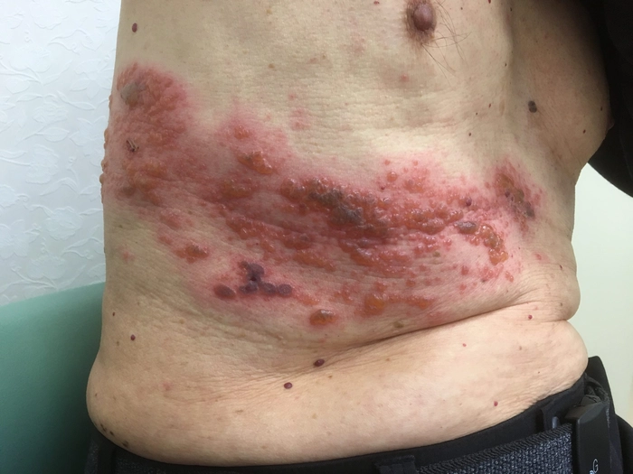 eruptie cutanata provocata de zona zoster pe corpul unei persoane